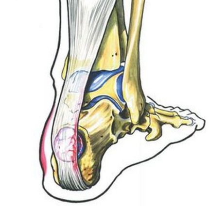 tendinopathies achille bruay la buissiere